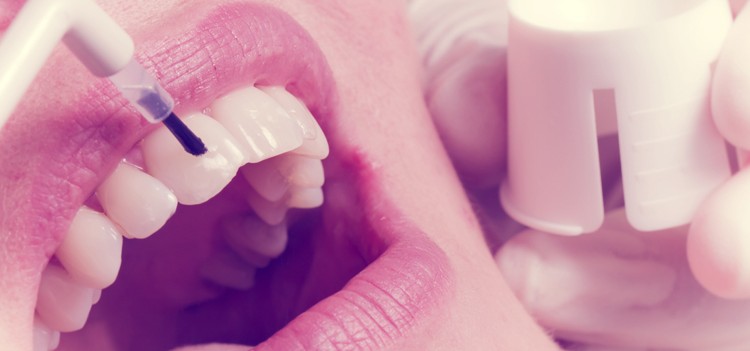 Qué es el blanqueamiento dental